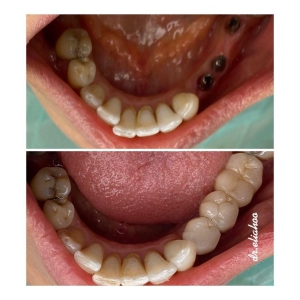 جراحی کاشت ایمپلنت دندان در یک روز