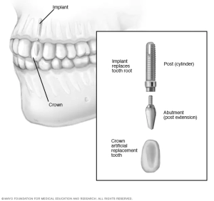 جراحی کاشت ایمپلنت دندان