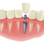 درباره ایمپلنت های دندانی چه میدانید ایمپلنت در یک روزه