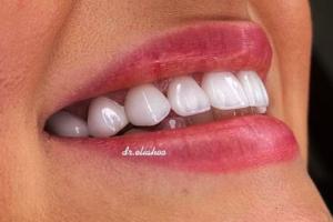 روکش و لمینت زیبایی دندان