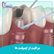 مراقبت و نگهداری از ایمپلنت دندان