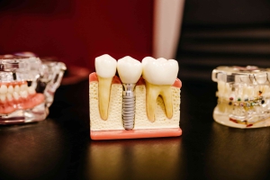 ایمپلنت دندان چقدر ایمنی دارد