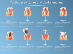 [تصویر:  bigstock-Tooth-Decay-Stages-And-Dental-2...00x223.jpg]