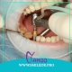 مرحله به مرحله با کاشت ایمپلنت دندان