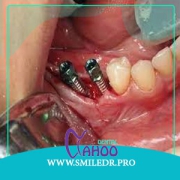 مزیت کاشت ایمپلنت دندان برای افراد بی دندان