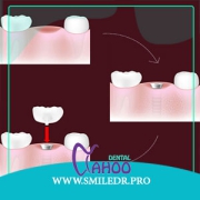 فرآیند زمانی ایمپلنت دندان راهنمای کامل