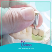 طول عمر ایمپلنت دندان چقدر است