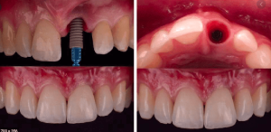 هزینه ایمپلنت دندان جلو روش جدید جایگزین ایمپلنت ایمپلنت دندان جلو فک پایین