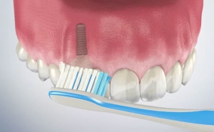 [تصویر:  dental-implant-home-care-dos-and-donts-7...00x186.jpg]