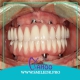 عوارض ایمپلنت و مشکلات کاشت دندان