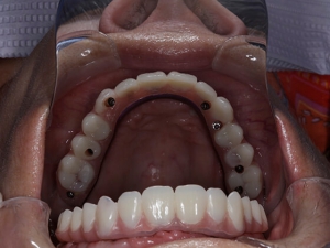 ایمپلنت دندان در تهران با دندانپزشک متخصص