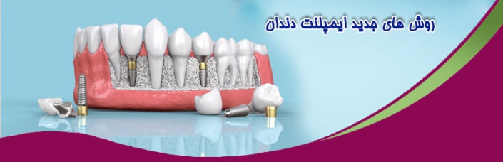 کاشت روش های جدید ایمپلنت دندان