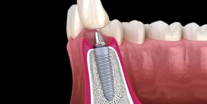 [تصویر:  Dental-Implant-Procedure-300x151.jpg]