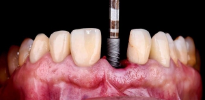 [تصویر:  Dental-Implant2-300x146.jpg]