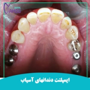 ایمپلنت دندان برای دندانهای آسیاب