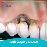 ایمپلنت های دندانی و التهاب لثه
