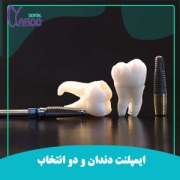 ایمپلنت دندان و دو انتخاب