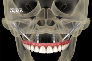 بهترین نوع ایمپلنت دندان چیست