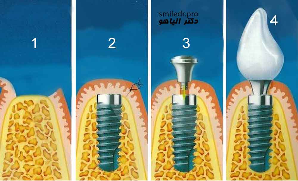 آیا ایمپلنت های دندانی توانایی جویدن را بالا می برند؟
