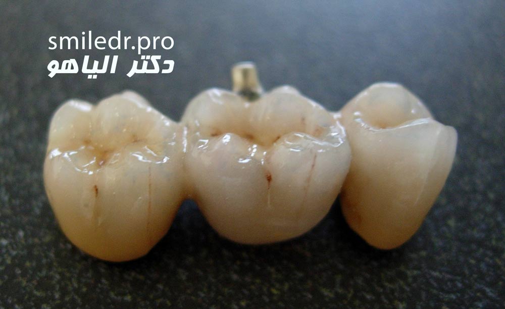 معایب داشتن پل دندانی به جای ایمپلنت 