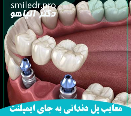معایب داشتن پل دندانی به جای ایمپلنت