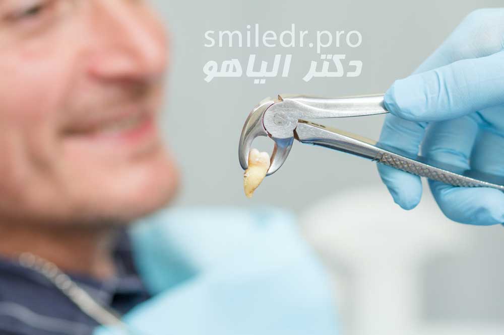 فاصله کشیدن دندان تا کاشت ایمپلنت