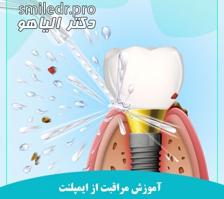 آموزش های بهداشتی برای ایمپلنت دندان