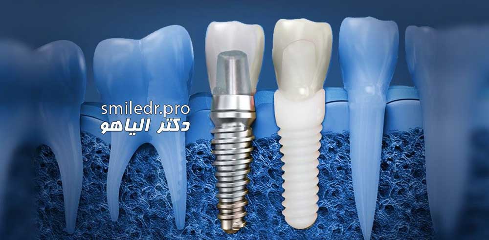 آموزش های بهداشتی برای ایمپلنت دندان 